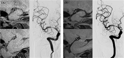 High-Resolution MR for Follow-Up of Intracranial Steno-Occlusive Disease Treated by Endovascular Treatment